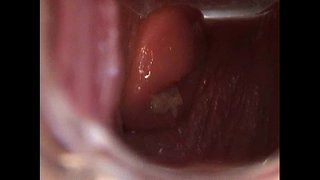 Avy باز مهبل, اسپکولوم